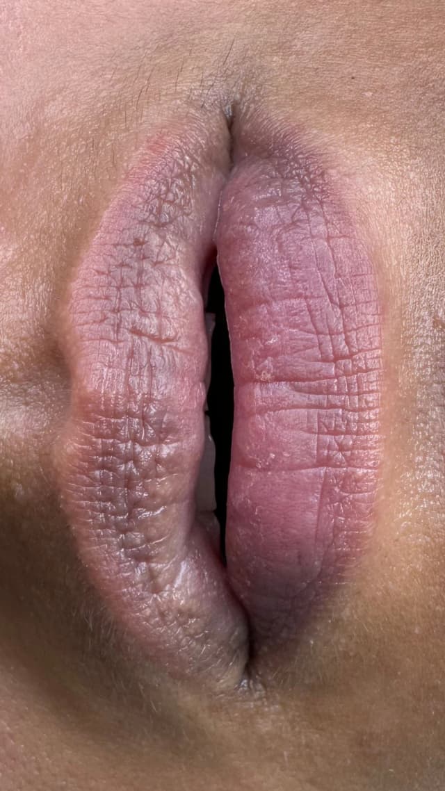 Dark Lip Correction treatment