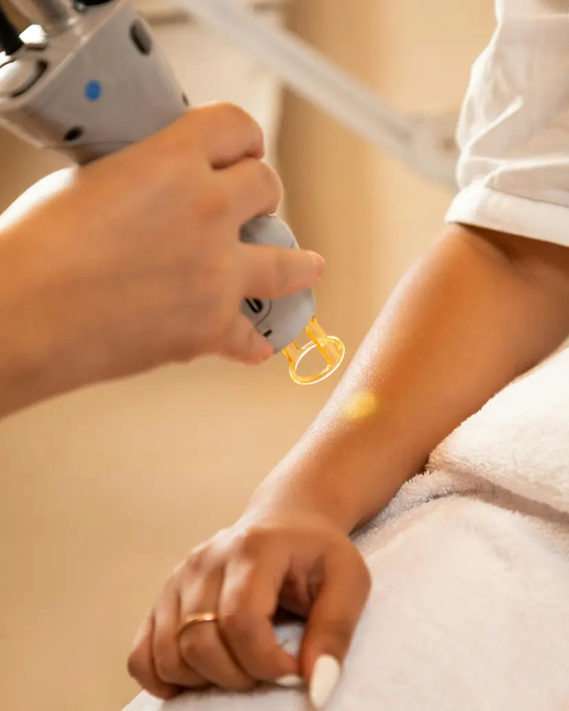 Pico laser treatment