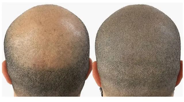 Scalp Micro Pigmentation treatment in India at Elora's PMU