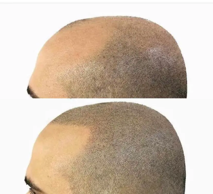 Before and after Scalp Micropigmentation showing a fuller hairline